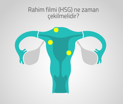 Uterin Miyom Embolizasyonunun (UME) Başarı Oranı Nedir?