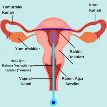 Uterin Miyom Embolizasyonu (UME) Kime Yapılabilir? Kimlere Yapılmaz?